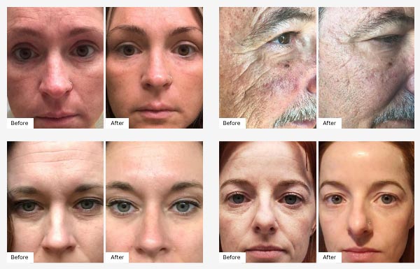 Before and After Real Result photos of people using the Advanced Skincare Set.